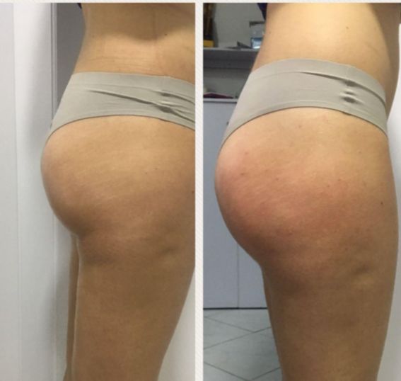 Resultado real de tratamiento corporal en Splendor Beauty